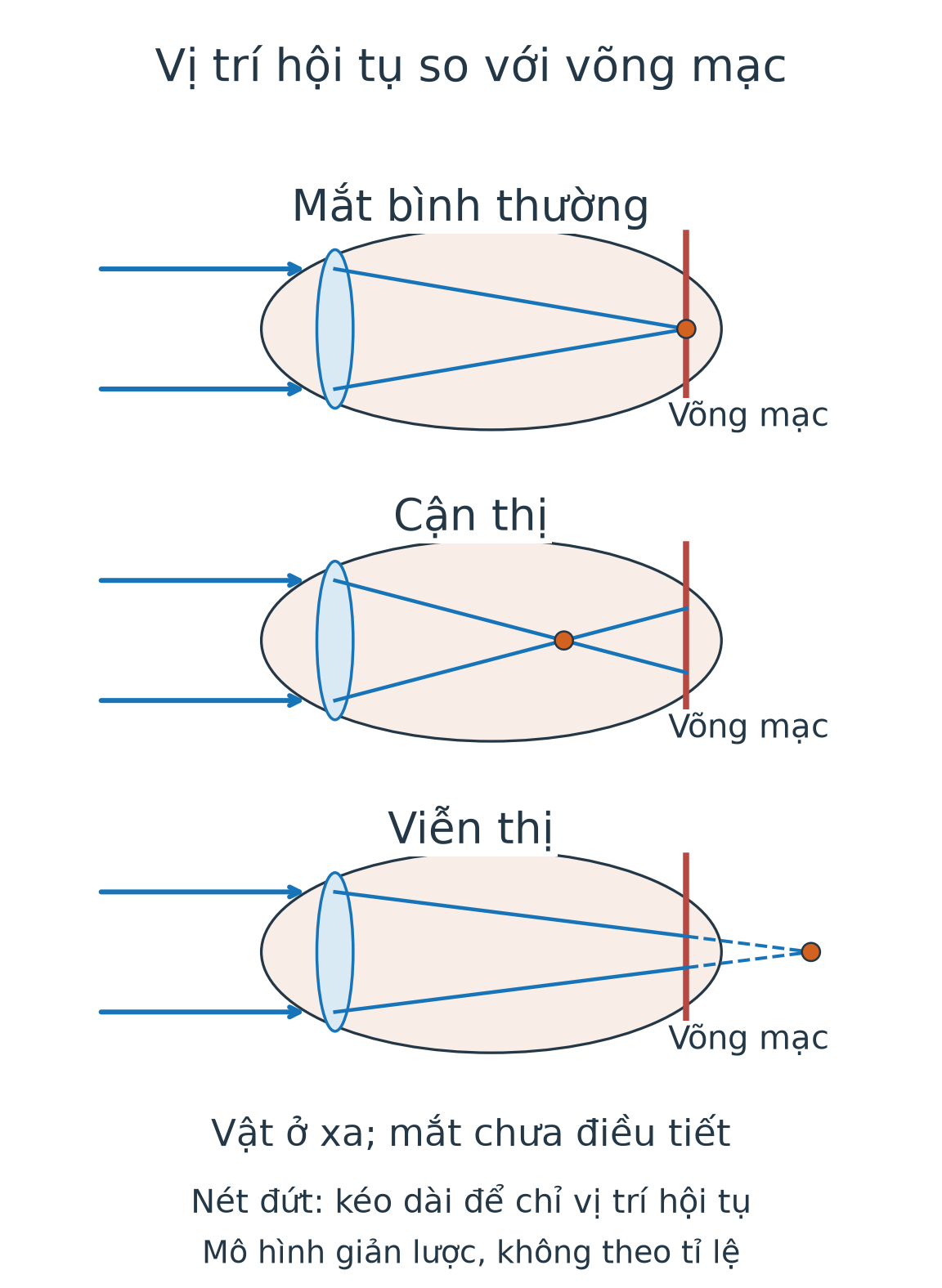 Ba mô hình ánh sáng từ vật ở xa: mắt bình thường hội tụ trên võng mạc, cận thị trước võng mạc, viễn thị có điểm hội tụ ở sau võng mạc được kéo dài nét đứt.