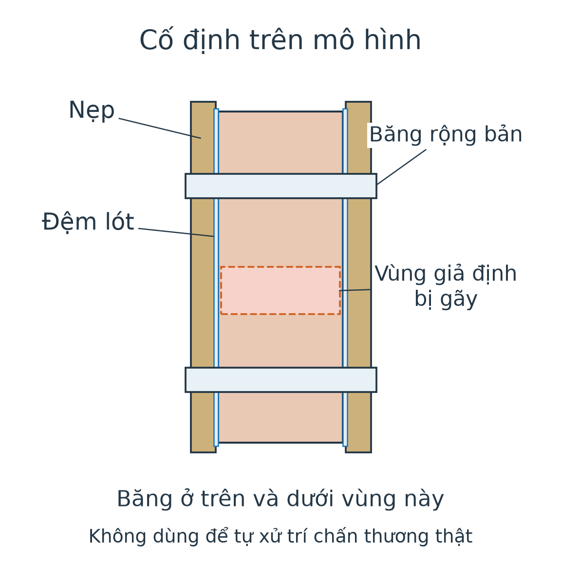 Mô hình chi với hai nẹp có đệm ở hai bên, hai băng rộng bản nằm phía trên và dưới vùng giả định bị gãy; không đặt băng trên vùng này.